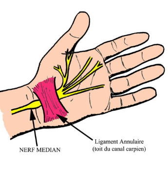 Nerf-median-poignet-canal-carpien-schema | L'institut de ...