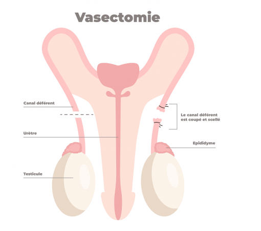 Schéma la vasectomie