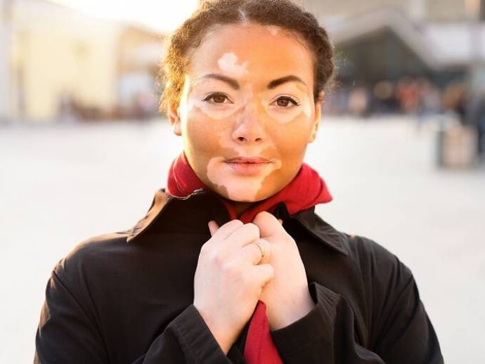 Le vitiligo, ça vous parle ?