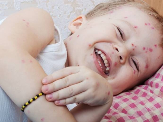 Connaissez-vous vraiment la varicelle et ses conséquences ?