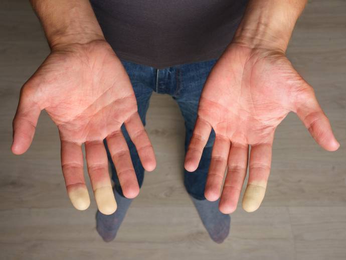 10 faits surprenants sur le syndrome de Raynaud !