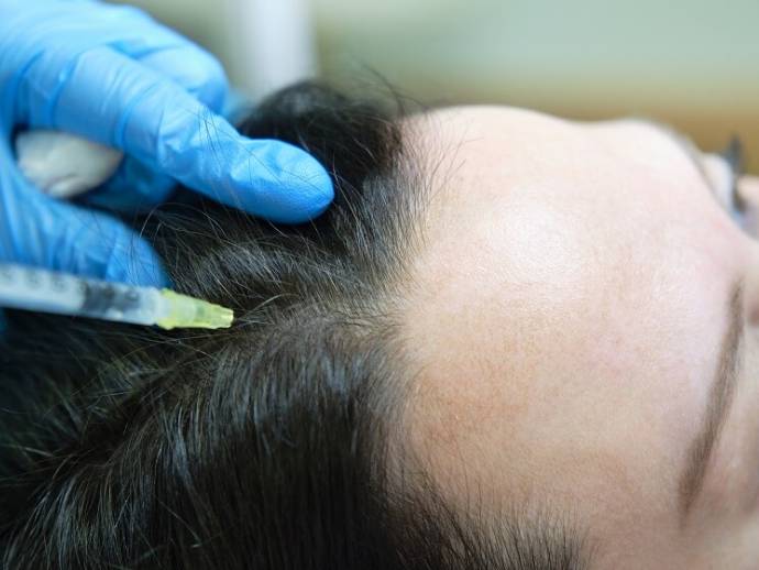 Perte de cheveux chez la femme : que faire ?