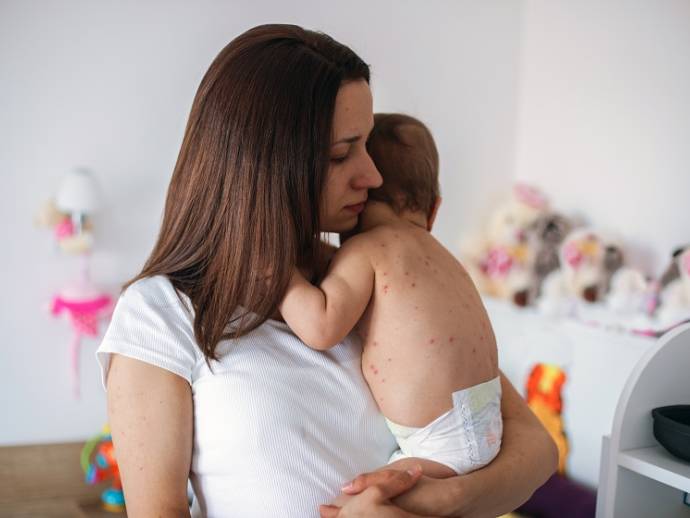 Roséole : une maladie infantile bénigne mais méconnue