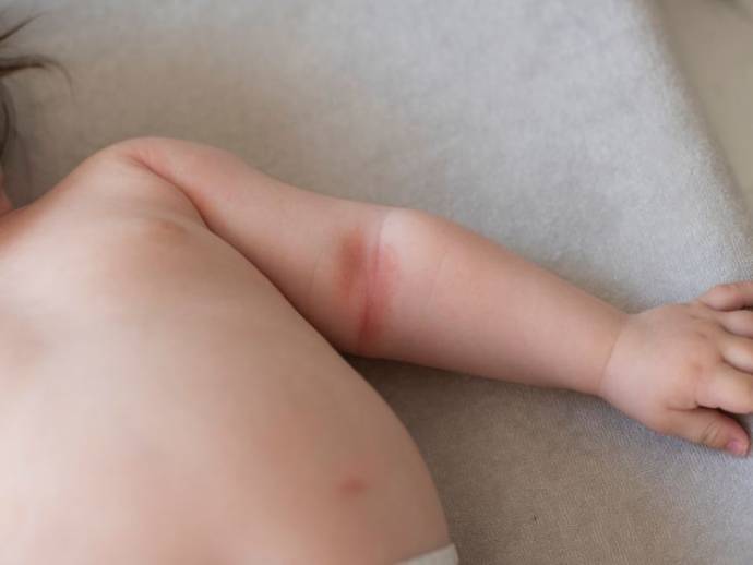 Eczéma du nourrisson : de quoi parle-t-on exactement ?