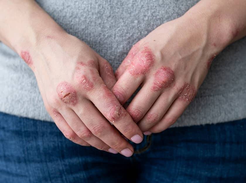 Une main de personne ayant la maladie de la psoriasis