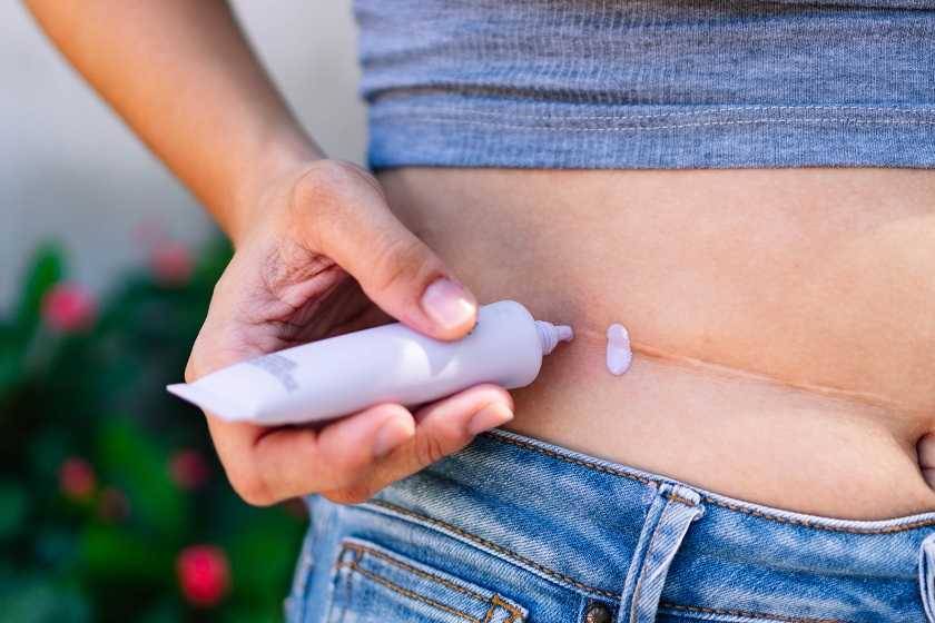 Femme qui applique de la crème sur une cicatrice
