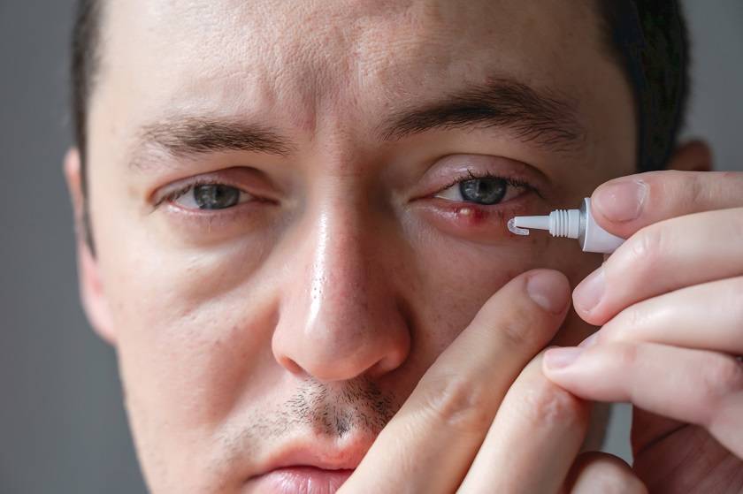 homme qui applique de la pommade sur un chalazion